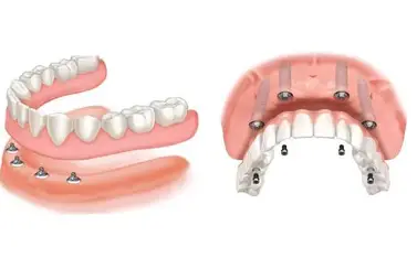 Full Mouth Rehabilitation Process